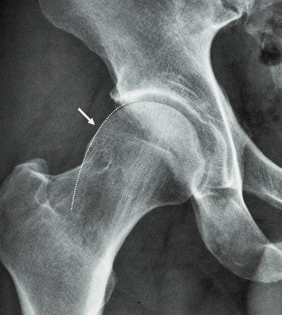 図10 Pistol grip deformity （ピストルグリップ変形）