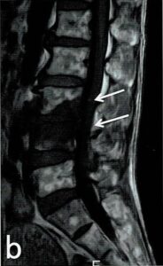 炎 脊椎 化膿 性 化膿性脊椎炎・椎間板炎・椎体炎のMRI画像診断のポイント！